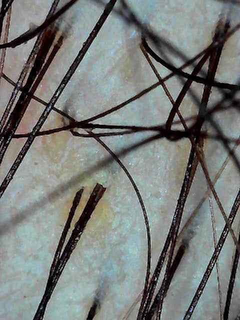 Scalp Analysis (Complimentary)